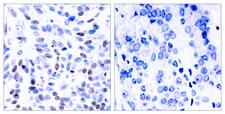 NFKB2 Antibody - Immunohistochemical analysis of paraffin-embedded breast carcinoma. Left: Using NF-?B p100/p52 (Ab-865) Antibody; Right: The same antibody preincubated with synthesized peptide.