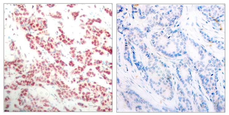 NFKB2 Antibody - Immunohistochemistry analysis of paraffin-embedded human breast carcinoma, using NF-kappaB p100/p52 (Phospho-Ser865) Antibody. The picture on the right is blocked with the phospho peptide.