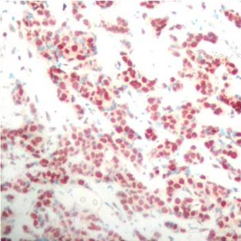 NFKB2 Antibody - Immunohistochemical analysis of paraffin-embedded human breast carcinoma tissue.