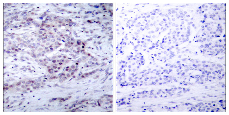 NFKB2 Antibody - Immunohistochemistry analysis of paraffin-embedded human breast carcinoma, using NF-kappaB p100/p52 (Phospho-Ser869) Antibody. The picture on the right is blocked with the phospho peptide.
