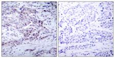 NFKB2 Antibody - Immunohistochemistry analysis of paraffin-embedded human breast carcinoma, using NF-kappaB p100/p52 (Phospho-Ser869) Antibody. The picture on the right is blocked with the phospho peptide.