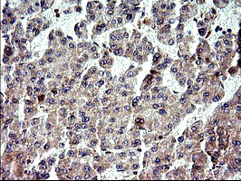 NFKBIA / IKB Alpha / IKBA Antibody - IHC of paraffin-embedded Carcinoma of Human liver tissue using anti-NFKBIA mouse monoclonal antibody. (Heat-induced epitope retrieval by 10mM citric buffer, pH6.0, 120°C for 3min).