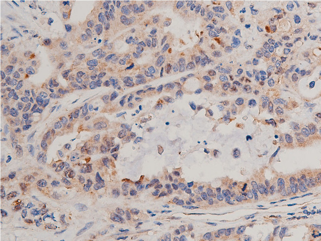 NFKBIA / IKB Alpha / IKBA Antibody - 1:50 staining human colon carcinoma tissue by IHC-P. The tissue was formaldehyde fixed and a heat mediated antigen retrieval step in citrate buffer was performed. The tissue was then blocked and incubated with the antibody for 1.5 hours at 22°C. An HRP conjugated goat anti-rabbit antibody was used as the secondary.