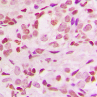 NFKBIA / IKB Alpha / IKBA Antibody - Immunohistochemical analysis of IKB alpha staining in human breast cancer formalin fixed paraffin embedded tissue section. The section was pre-treated using heat mediated antigen retrieval with sodium citrate buffer (pH 6.0). The section was then incubated with the antibody at room temperature and detected using an HRP conjugated compact polymer system. DAB was used as the chromogen. The section was then counterstained with hematoxylin and mounted with DPX.