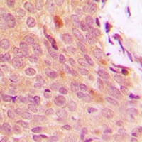 NFKBIA / IKB Alpha / IKBA Antibody - Immunohistochemical analysis of IKB alpha (pY42) staining in human breast cancer formalin fixed paraffin embedded tissue section. The section was pre-treated using heat mediated antigen retrieval with sodium citrate buffer (pH 6.0). The section was then incubated with the antibody at room temperature and detected using an HRP polymer system. DAB was used as the chromogen. The section was then counterstained with hematoxylin and mounted with DPX.