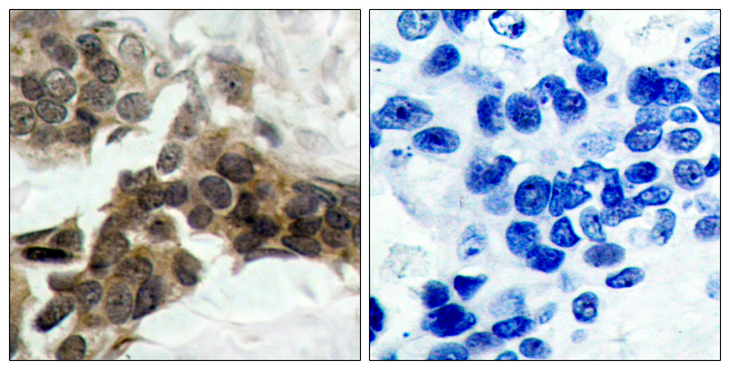 NFKBIA / IKB Alpha / IKBA Antibody - Immunohistochemistry analysis of paraffin-embedded human breast carcinoma, using IkappaB-alpha (Phospho-Ser32/Ser36) Antibody. The picture on the right is blocked with the phospho peptide.