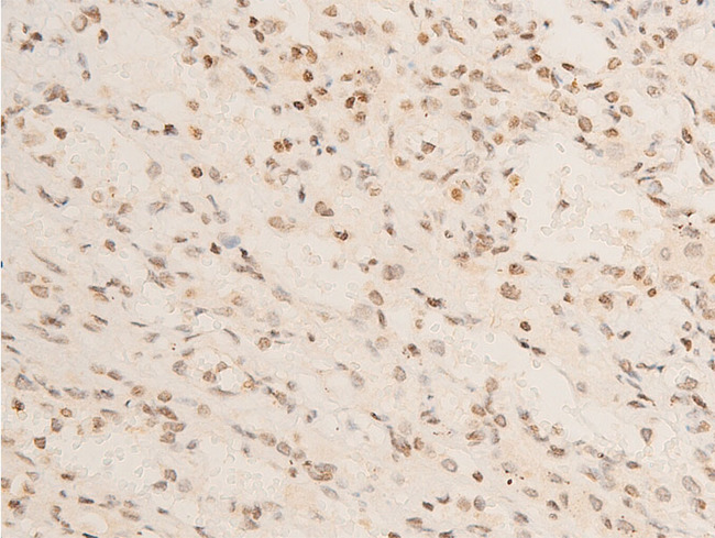 NFKBIA / IKB Alpha / IKBA Antibody - 1:100 staining human TB tissue by IHC-P. The tissue was formaldehyde fixed and a heat mediated antigen retrieval step in citrate buffer was performed. The tissue was then blocked and incubated with the antibody for 1.5 hours at 22°C. An HRP conjugated goat anti-rabbit antibody was used as the secondary.