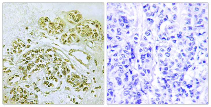 NFKBIA / IKB Alpha / IKBA Antibody - Immunohistochemistry analysis of paraffin-embedded human breast carcinoma, using IkappaB-alpha (Phospho-Tyr42) Antibody. The picture on the right is blocked with the phospho peptide.