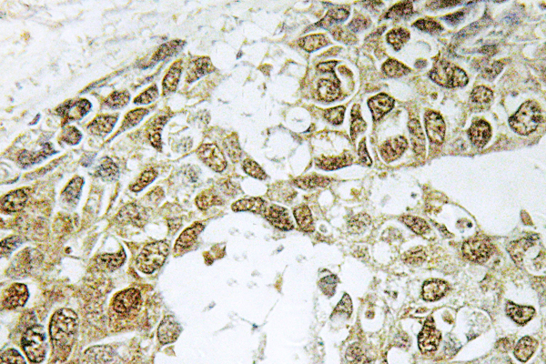 NFKBIA / IKB Alpha / IKBA Antibody - IHC of IB- (S36) pAb in paraffin-embedded human breast carcinoma tissue.