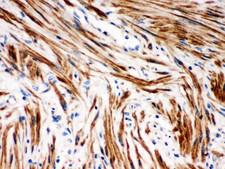 NFKBIB / IKB Beta / IKBB Antibody - IKB beta antibody IHC-paraffin: Human Intestinal Cancer Tissue.