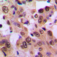 NFKBIB / IKB Beta / IKBB Antibody - Immunohistochemical analysis of IKK beta (pS23) staining in human breast cancer formalin fixed paraffin embedded tissue section. The section was pre-treated using heat mediated antigen retrieval with sodium citrate buffer (pH 6.0). The section was then incubated with the antibody at room temperature and detected using an HRP conjugated compact polymer system. DAB was used as the chromogen. The section was then counterstained with hematoxylin and mounted with DPX.