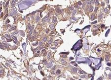 NFKBIB / IKB Beta / IKBB Antibody - 1:100 staining human breast carcinoma tissue by IHC-P. The tissue was formaldehyde fixed and a heat mediated antigen retrieval step in citrate buffer was performed. The tissue was then blocked and incubated with the antibody for 1.5 hours at 22°C. An HRP conjugated goat anti-rabbit antibody was used as the secondary.
