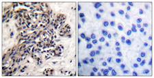 NFKBIB / IKB Beta / IKBB Antibody - P-peptide - + Immunohistochemical analysis of paraffin-embedded human breast carcinoma tissue using HSP90B (phospho-Ser254) antibody.
