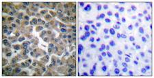 NFKBIE / IKB Epsilon Antibody - Immunohistochemistry analysis of paraffin-embedded human breast carcinoma tissue, using IkappaB-epsilon Antibody. The picture on the right is blocked with the synthesized peptide.