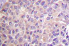NFKBIE / IKB Epsilon Antibody - IHC of IB- (D17) pAb in paraffin-embedded human breast carcinoma tissue.
