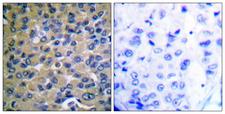 NFKBIE / IKB Epsilon Antibody - Immunohistochemistry analysis of paraffin-embedded human breast carcinoma, using IkappaB-epsilon (Phospho-Ser22) Antibody. The picture on the right is blocked with the phospho peptide.