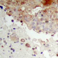 NFKBIE / IKB Epsilon Antibody - Immunohistochemical analysis of IKB epsilon (pS22) staining in human prostate cancer formalin fixed paraffin embedded tissue section. The section was pre-treated using heat mediated antigen retrieval with sodium citrate buffer (pH 6.0). The section was then incubated with the antibody at room temperature and detected using an HRP polymer system. DAB was used as the chromogen. The section was then counterstained with hematoxylin and mounted with DPX.