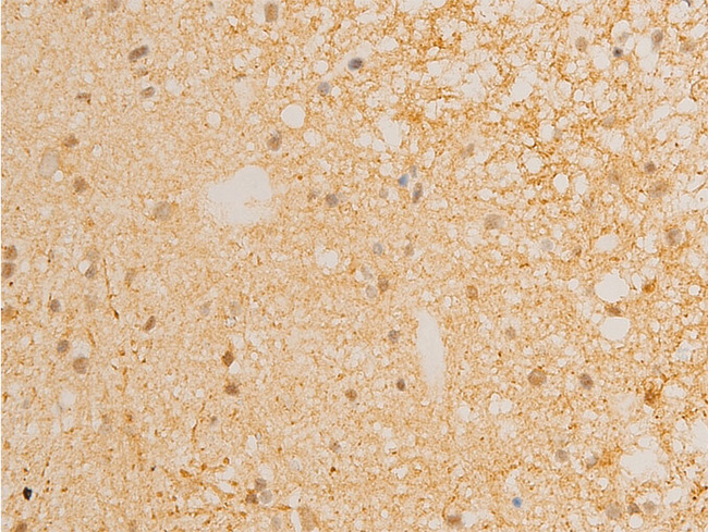 NFKBIE / IKB Epsilon Antibody - 1:100 staining human glioma tissue by IHC-P. The tissue was formaldehyde fixed and a heat mediated antigen retrieval step in citrate buffer was performed. The tissue was then blocked and incubated with the antibody for 1.5 hours at 22°C. An HRP conjugated goat anti-rabbit antibody was used as the secondary.