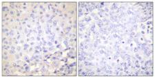 NFKBIE / IKB Epsilon Antibody - P-peptide - + Immunohistochemical analysis of paraffin-embedded human breast carcinoma tissue using I?B-e (phospho-Ser22) antibody.
