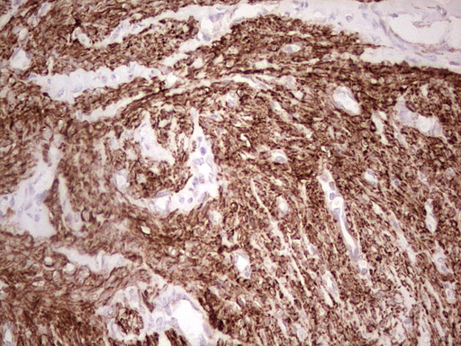 NFS1 Antibody - Immunohistochemical staining of paraffin-embedded Adenocarcinoma of Human endometrium tissue using anti-NFS1 mouse monoclonal antibody. (Heat-induced epitope retrieval by 1 mM EDTA in 10mM Tris, pH8.5, 120C for 3min,