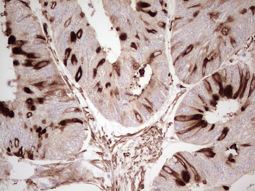 NFS1 Antibody - Immunohistochemical staining of paraffin-embedded Adenocarcinoma of Human colon tissue using anti-NFS1 mouse monoclonal antibody. (Heat-induced epitope retrieval by 1 mM EDTA in 10mM Tris, pH8.5, 120C for 3min,