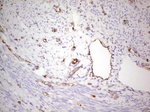 NFS1 Antibody - Immunohistochemical staining of paraffin-embedded Adenocarcinoma of Human endometrium tissue using anti-NFS1 mouse monoclonal antibody. (Heat-induced epitope retrieval by 1 mM EDTA in 10mM Tris, pH8.5, 120C for 3min,