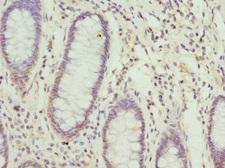 NFS1 Antibody - Immunohistochemistry of paraffin-embedded human colon cancer tissue at dilution 1:100