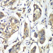 NFS1 Antibody - Immunohistochemistry of paraffin-embedded human liver cancer using NFS1 antibody at dilution of 1:100 (40x lens).