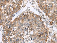 NFS1 Antibody - Immunohistochemistry of paraffin-embedded Human liver cancer tissue  using NFS1 Polyclonal Antibody at dilution of 1:50(×200)
