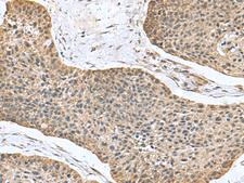 NFS1 Antibody - Immunohistochemistry of paraffin-embedded Human esophagus cancer tissue  using NFS1 Polyclonal Antibody at dilution of 1:100(×200)