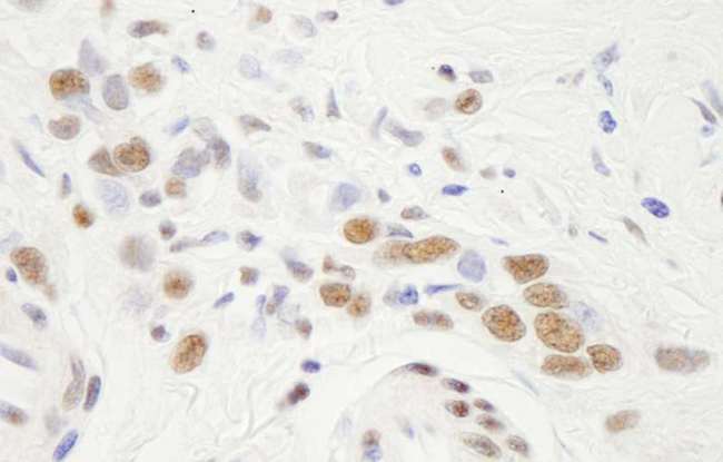 NFYA Antibody - Detection of Human NF-YA by Immunohistochemistry. Sample: FFPE section of human Linitis Plastica stomach cancer. Antibody: Affinity purified rabbit anti-NF-YA used at a dilution of 1:250.