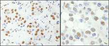 NFYA Antibody - Detection of Human and Mouse NF-YA by Immunohistochemistry. Sample: FFPE section of human breast carcinoma (left) and mouse hybridoma tumor (right). Antibody: Affinity purified rabbit anti-NF-YA used at a dilution of 1:200 (1 ug/ml). Detection: DAB.