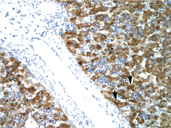NFYA Antibody - NFYA antibody ARP31380_P050-NP_002496-NFYA (nuclear transcription factor Y, alpha) Antibody was used in IHC to stain formalin-fixed, paraffin-embedded human liver.  This image was taken for the unconjugated form of this product. Other forms have not been tested.