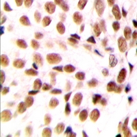 NFYB Antibody - Immunohistochemical analysis of NFYB staining in human breast cancer formalin fixed paraffin embedded tissue section. The section was pre-treated using heat mediated antigen retrieval with sodium citrate buffer (pH 6.0). The section was then incubated with the antibody at room temperature and detected with HRP and DAB as chromogen. The section was then counterstained with hematoxylin and mounted with DPX.