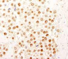NFYC Antibody - Detection of Human NF-YC by Immunohistochemistry. Sample: FFPE section of human testicular seminoma. Antibody: Affinity purified rabbit anti-NF-YC used at a dilution of 1:1000 (1 ug/ml). Detection: DAB.