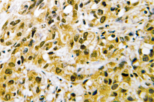 NFYC Antibody - IHC of NF-YC (W85) pAb in paraffin-embedded human liver carcinoma tissue.