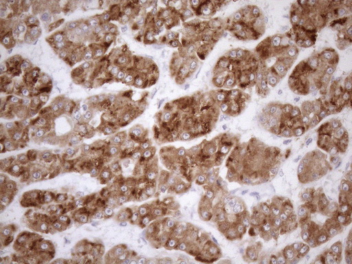 NGDN Antibody - Immunohistochemical staining of paraffin-embedded Carcinoma of Human liver tissue using anti-NGDN mouse monoclonal antibody. (Heat-induced epitope retrieval by 1mM EDTA in 10mM Tris buffer. (pH8.5) at 120°C for 3 min. (1:150)