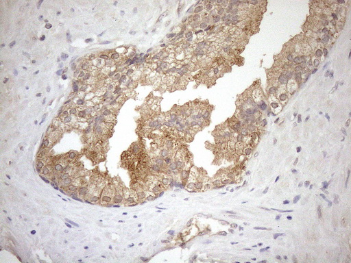 NGDN Antibody - Immunohistochemical staining of paraffin-embedded Carcinoma of Human prostate tissue using anti-NGDN mouse monoclonal antibody. (Heat-induced epitope retrieval by 1mM EDTA in 10mM Tris buffer. (pH8.5) at 120°C for 3 min. (1:150)
