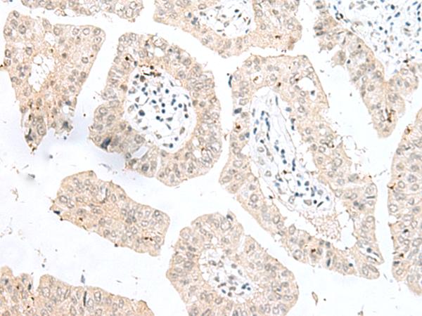 NGEF / EPHEXIN Antibody - Immunohistochemistry of paraffin-embedded Human liver cancer tissue  using NGEF Polyclonal Antibody at dilution of 1:35(×200)