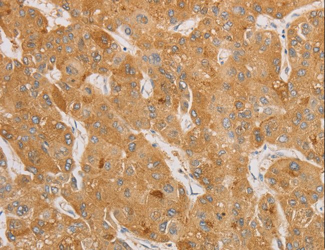 NGF Antibody - Immunohistochemistry of paraffin-embedded Human thyroid cancer using NGF Polyclonal Antibody at dilution of 1:50.