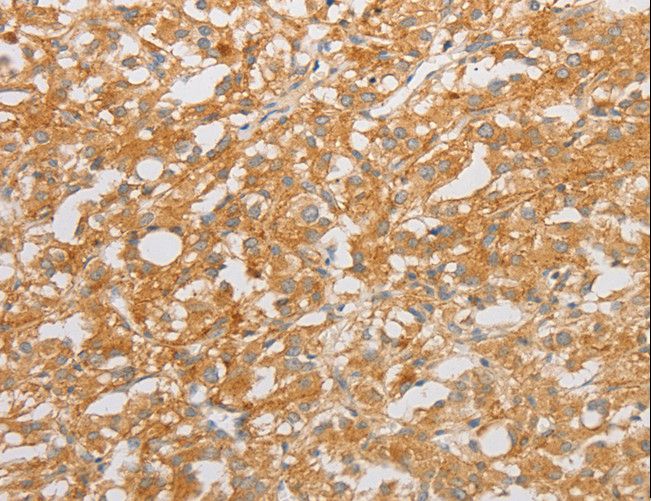 NGF Antibody - Immunohistochemistry of paraffin-embedded Human thyroid cancer using NGF Polyclonal Antibody at dilution of 1:50.