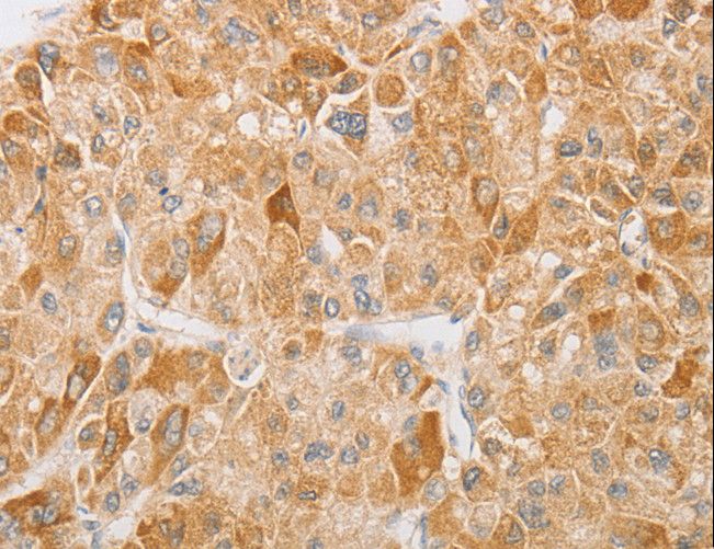 NGF Antibody - Immunohistochemistry of paraffin-embedded Human liver cancer using NGF Polyclonal Antibody at dilution of 1:40.