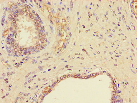 NGF Antibody - Immunohistochemistry of paraffin-embedded human prostate cancer using NGF Antibody at dilution of 1:100