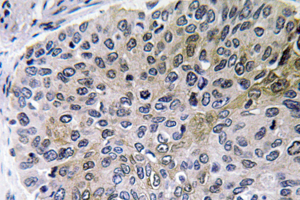 NGF Antibody - Immunohistochemistry analysis of NGF antibody in paraffin-embedded human lung carcinoma tissue.