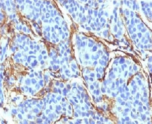 NGFR / CD271 / TNR16 Antibody - IHC testing of FFPE human melanoma with CD271 antibody (clone CDLA271).  This image was taken for the unmodified form of this product. Other forms have not been tested.