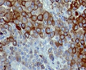 NGFR / CD271 / TNR16 Antibody - IHC testing of FFPE human melanoma with CD271 antibody (clone CDLA271).  This image was taken for the unmodified form of this product. Other forms have not been tested.
