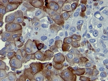 NGFR / CD271 / TNR16 Antibody - Formalin-fixed, paraffin-embedded human melanoma stained with p75NTR antibody (NGFR5).  This image was taken for the unmodified form of this product. Other forms have not been tested.