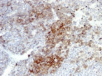 NGFR / CD271 / TNR16 Antibody - Formalin-fixed, paraffin-embedded human melanoma stained with NGF Receptor antibody (NGFR5 + NTR/912).  This image was taken for the unmodified form of this product. Other forms have not been tested.