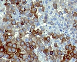 NGFR / CD271 / TNR16 Antibody - Formalin-fixed, paraffin-embedded human melanoma stained with NGFR antibody (NTR/912).  This image was taken for the unmodified form of this product. Other forms have not been tested.