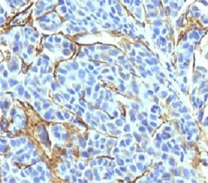 NGFR / CD271 / TNR16 Antibody - Formalin-fixed, paraffin-embedded human melanoma stained with NGFR antibody (NTR/912).  This image was taken for the unmodified form of this product. Other forms have not been tested.